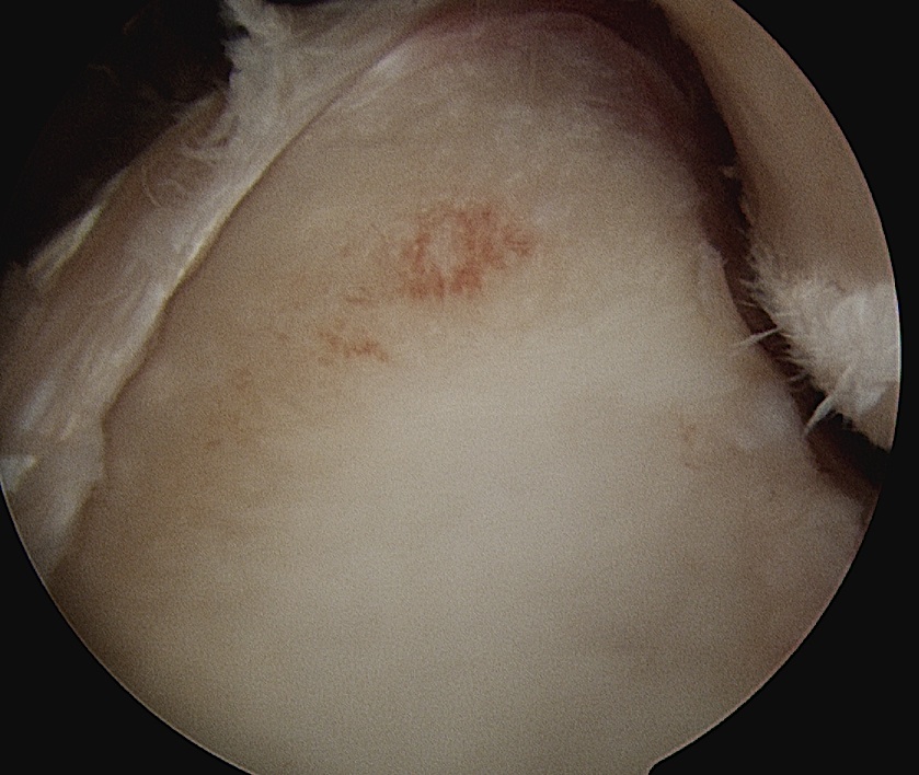 Glenoid Bone Loss